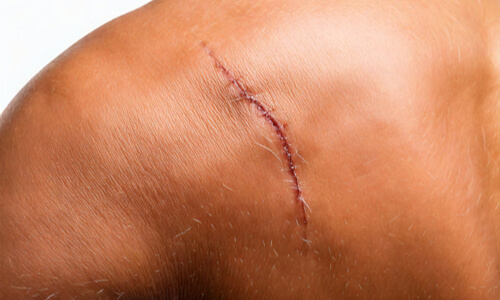 Post-surgical healing